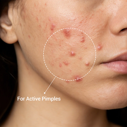 1.8% Encapsulated Salicylic Acid Acne Spot Treatment 20mL