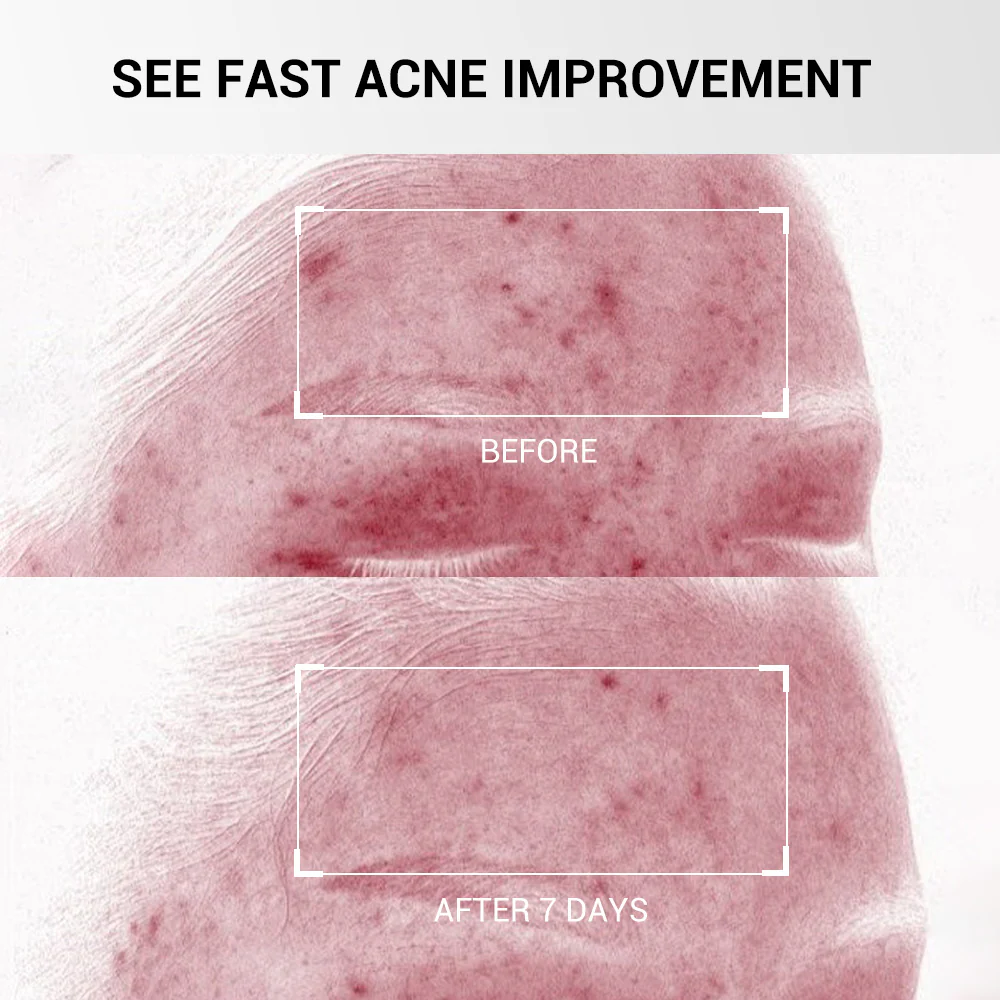 1.8% Encapsulated Salicylic Acid Acne Spot Treatment 20mL