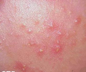 HORMONAL ACNE