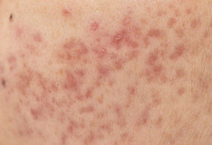 PIMPLE